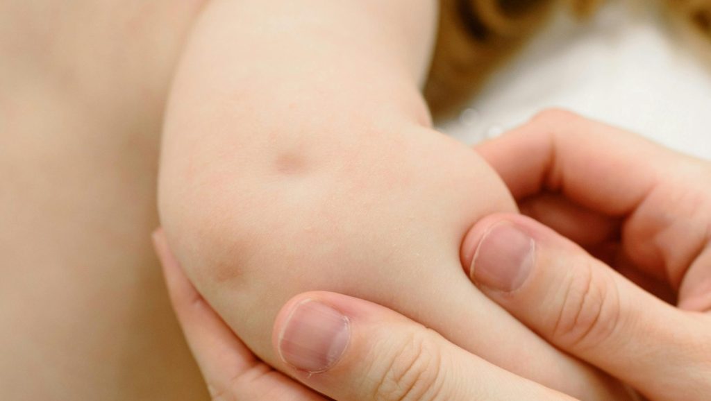 Eczema in Children – When to Worry and What Helps 1 Eczema in Children