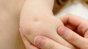 Eczema in Children
